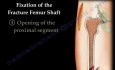 Fracture Of The Femur 