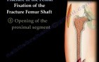 Fracture Of The Femur 
