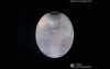Endoscopic 3Rd Ventriculostomy Surgery - Right Precoronary Approach
