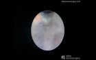 Endoscopic 3Rd Ventriculostomy Surgery - Right Precoronary Approach