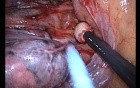 Uniportal VATS Azygos Lobe Dissection 