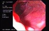 Adenocarcinoma of the Transverse Colon (2 of 2)
