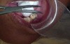 Dental Crown Removal - 