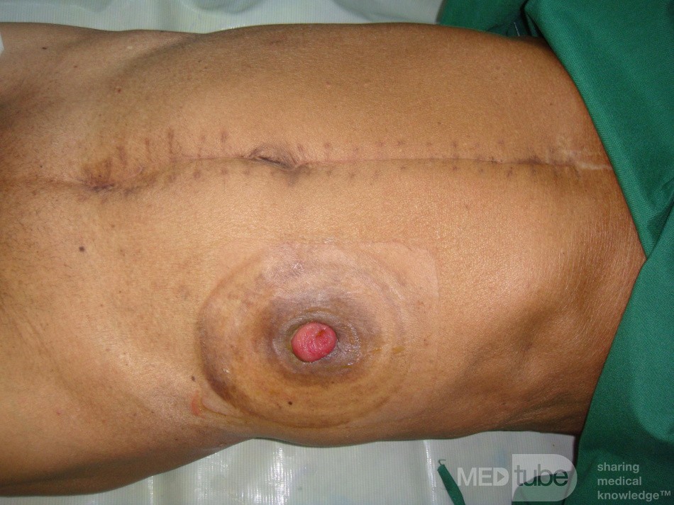 Colostomy