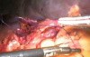 Laparoscopic splenectomy