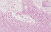 Cerebral Infarct, Recent