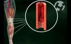 Blocked Blood Flow to the Lower Leg