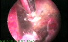 Treatment for Severe Intrauterine Adhesions by Use of Hysteroscopic Dissection