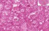 Thyroid - Graves Disease