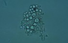 Urinoscopy - Cylindruria