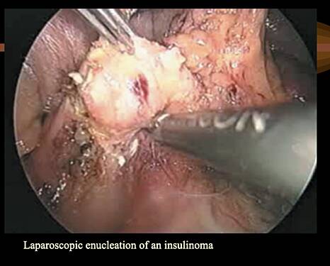 Endocrine Tumours of the Pancreas