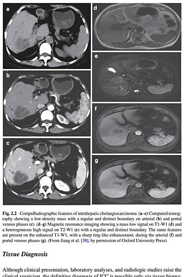 Intrahepatic Cholangiocarcinoma