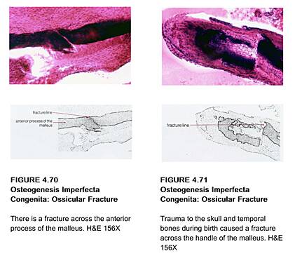 Diseases of the Ear Volume 4 The Otic Capsule