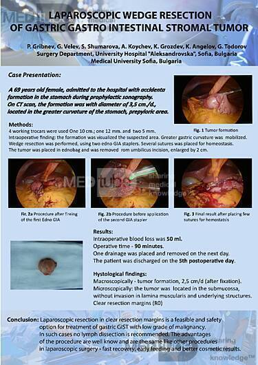 Laparoscopic Wedge Resection of Gastric Gastrointestinal Stromal Tumor (GIST)