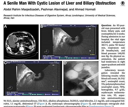 A Senile Man with Cystic Lesion of Liver