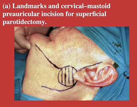 Parotid Gland