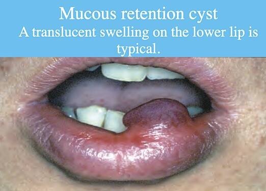 Salivary Glands