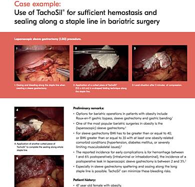 Use of TachoSil® in Bariatric Surgery for Sufficient Hemostasis and Sealing in Laparoscopic Sleeve Gastrectomy