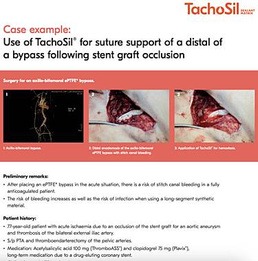 Use of TachoSil® for Suture Support of a Distal of a Bypass Following Stent Graft Occlusion, Prof. Thomas Hölzenbein