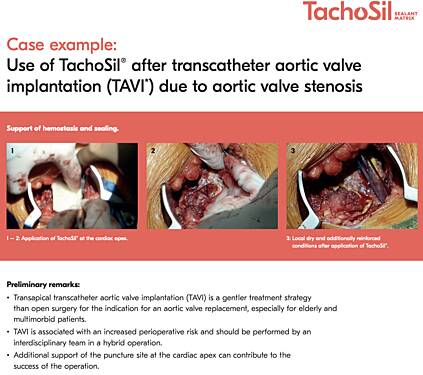 Use of TachoSil® for Efficient Haemostasis and Sealing After Transcatheter Aortic Valve Implantation (TAVI) Due to Aortic Valve Stenosis, Prof. Martin Czerny