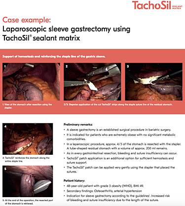Laparoscopic Sleeve Gastrectomy Using TachoSil® Sealant Matrix, Johannes Heimbucher