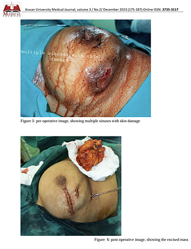 Outcome of Surgical Treatment of Complicated Periductal Mastitis