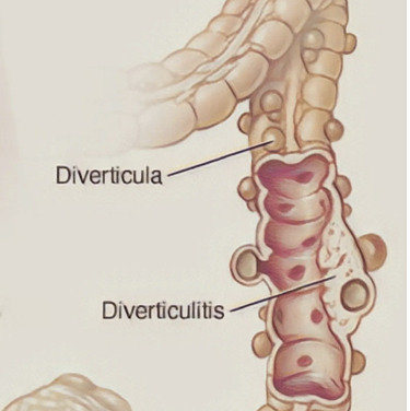 Sigmoid Resection vs Conservative Treatment After Diverticulitis Prespecified 4-Year Analysis of the LASER Randomized Clinic