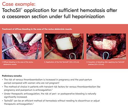 TachoSil® Application for Sufficient Haemostasis After a Caesarean Section Under Full Heparinization