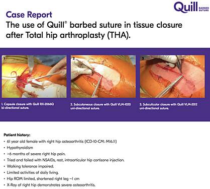 Case Report The Use of Quill® Barbed Suture in Tissue Closure After Total Hip Arthroplasty (THA)