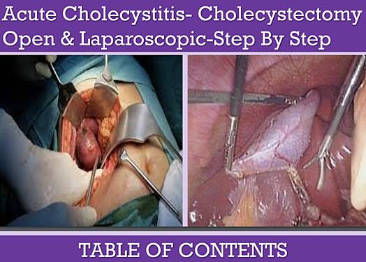 Acute Cholecystitis and Cholecystectomy - Open & Laparoscopic
