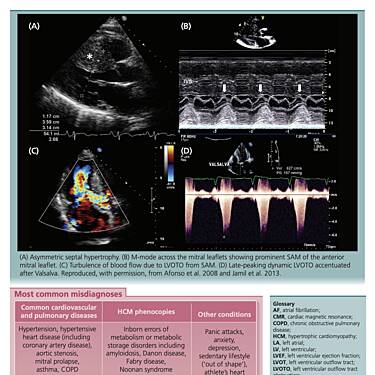 Echocardiography in Hypertrophic Cardiomyopathy