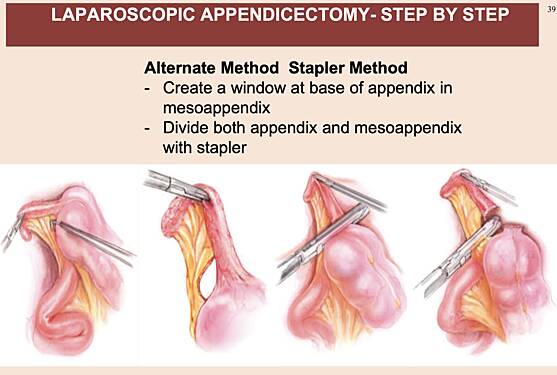 Acute Appendicitis - Appendicectomy - Open & Laparoscopic
