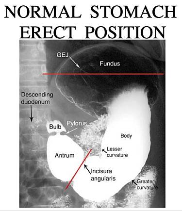 Surgical Radiology of Gastroduodenal Disorders
