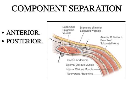 Surgical Management of Ventral Hernia
