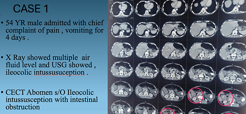 Efficacy of Minimally Invasive Surgery in Bowel Intussusception