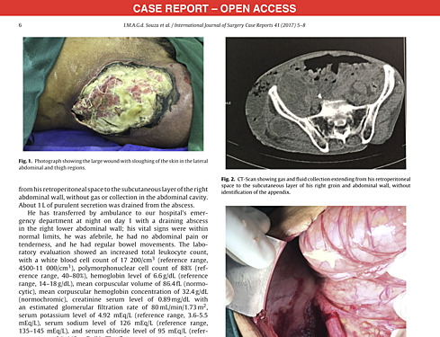 Case Report of Acute Appendicitis Complicated by a Cutaneous Fistula