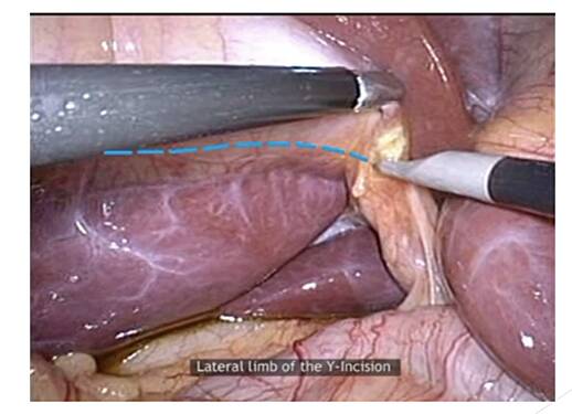 10 Pitfalls Point to Minimize Bile Duct Injuries During Laparoscopic Cholecystectomy