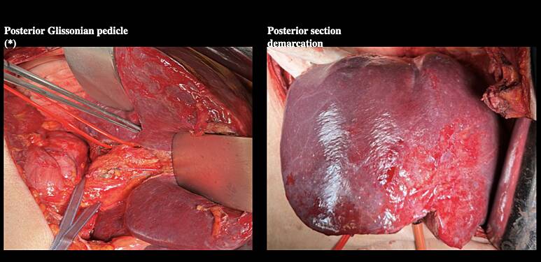 Posterior Right Sectionectomy with Resection of the Right Hepatic Vein, for Colon Cancer Metastasis