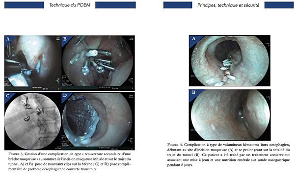 Peroral Endoscopic Myotomy (POEM)