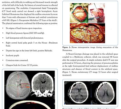 Acute Spontaneous Cerebral Hemorrhage in the Subdural Space - Clinical Case