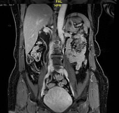 Psoic Bladder with Ureteral Reimplantation