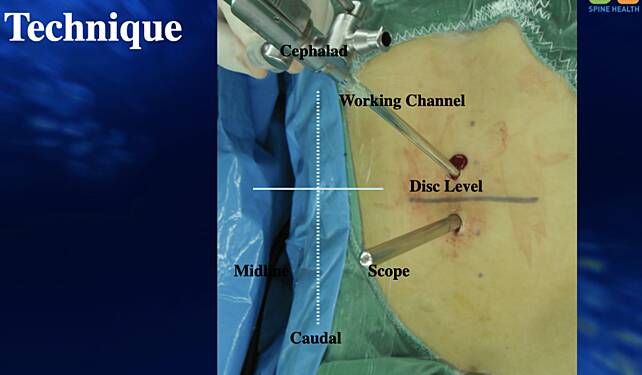 Unilateral Biportal Endoscopic  Segmental Sublaminoplasty for  Lumbar Spinal Stenosis