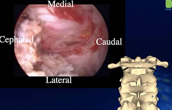 Unilateral Biportal Endoscopic Posterior Cervical Laminectomy and Discectomy 