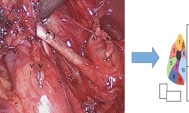 Uncommon Minimally Invasive S1+S3 Right Bisegmentectomy