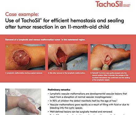 Use of TachoSil® for Efficient Hemostasis and Sealing After Tumor Resection in an 11-month-old Child