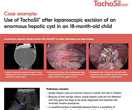 Use of TachoSil® After Laparoscopic Excision of an Enormous Hepatic Cyst in an 18-month-old Child