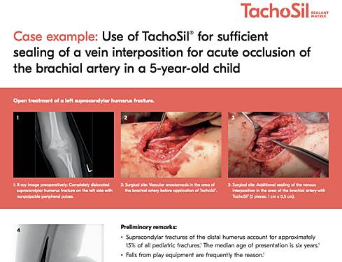 Use of TachoSil® For Sufficient Sealing of a Vein Interposition for Acute Occlusion of the Brachial Artery in a 5-year-old Child