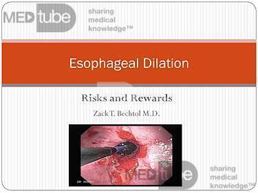 Esophageal Dilation Lecture