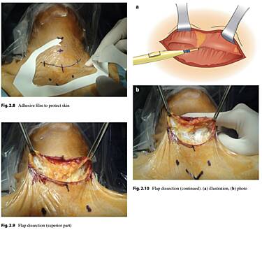 Atlas of Thyroid Surgery - Open, Endoscopic and Robotic Procedures