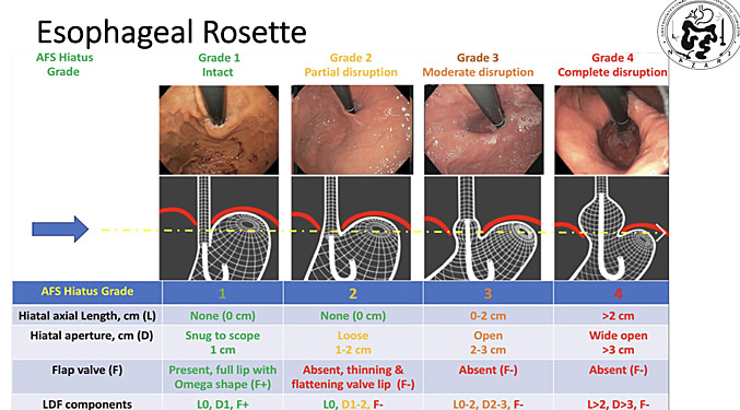 Role of Preoperative Endoscopy in Bariatric Surgery
